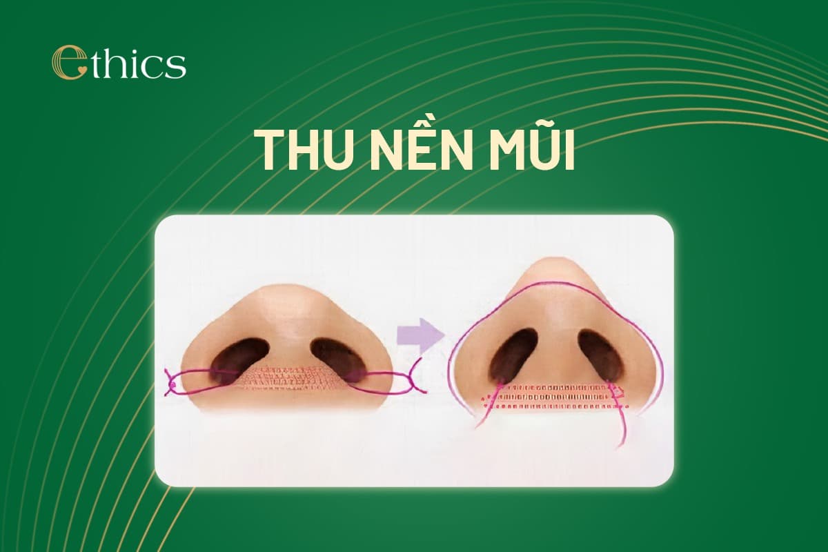 Nasal bridge lift