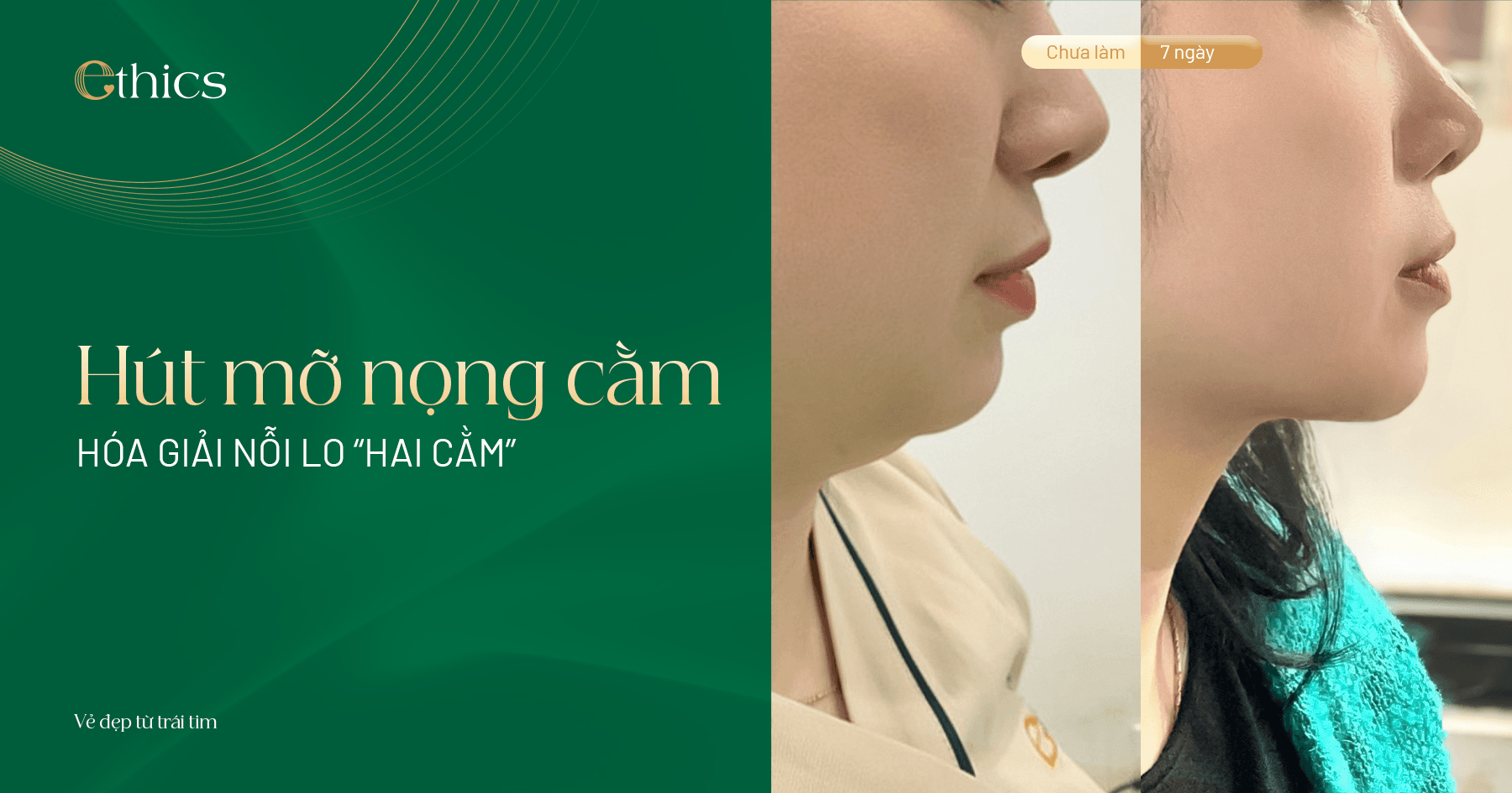 Submental Liposuction (Double Chin Removal)