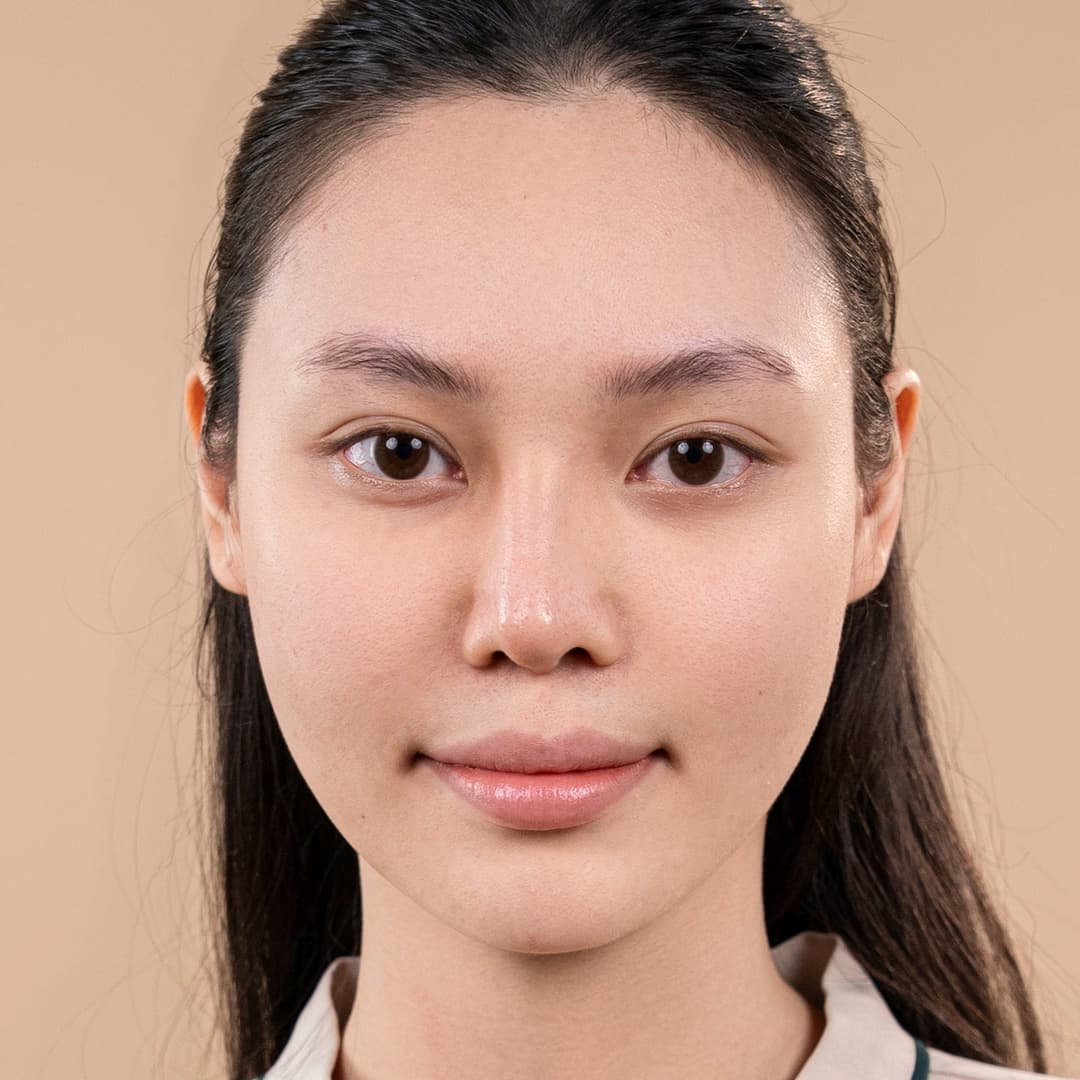 Client Luu Phuong Anh - Before One Fit rhinoplasty
