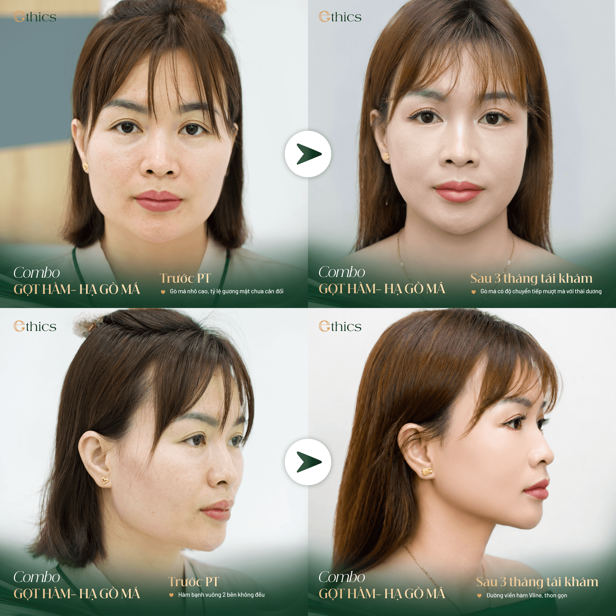 Chin cleft