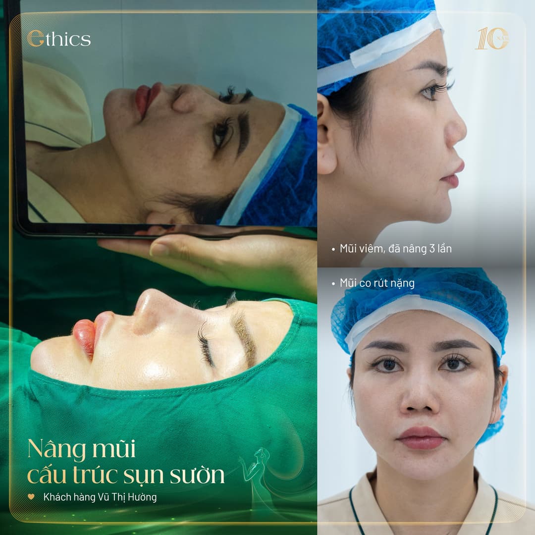 Ethics autologous cartilage grafting for nose reshaping