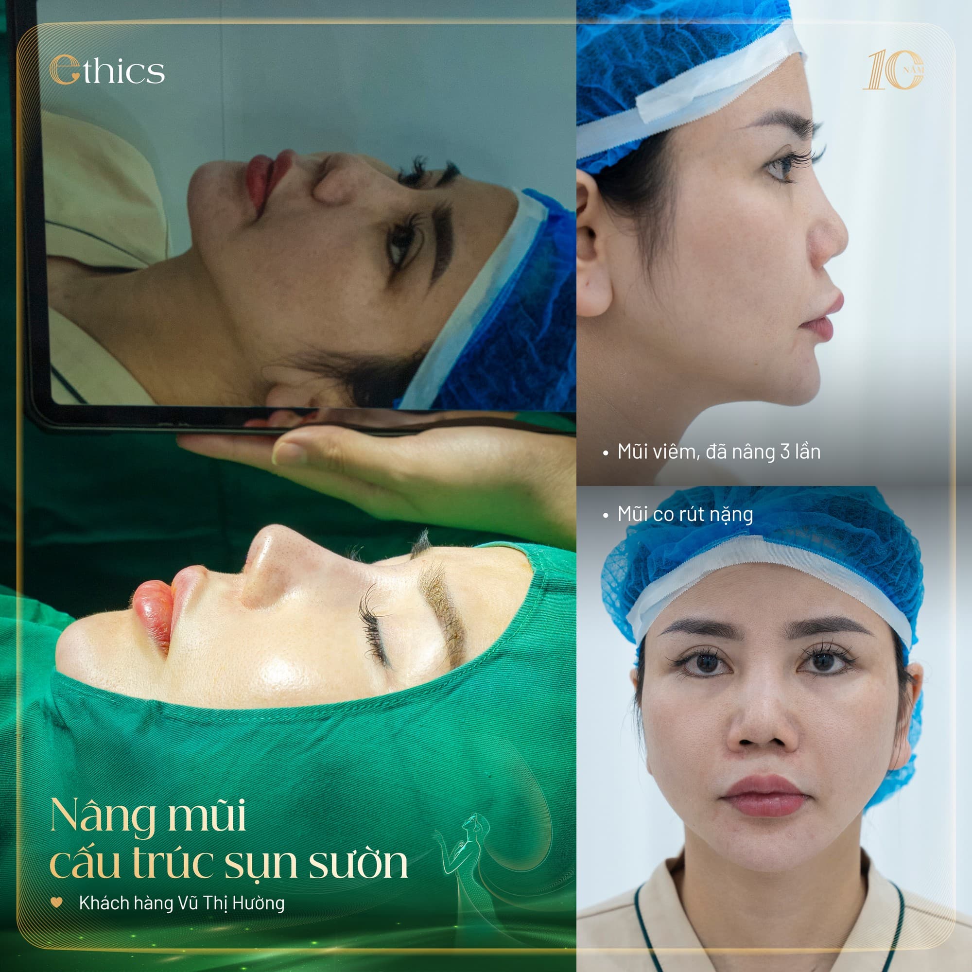 Cartilage grafting