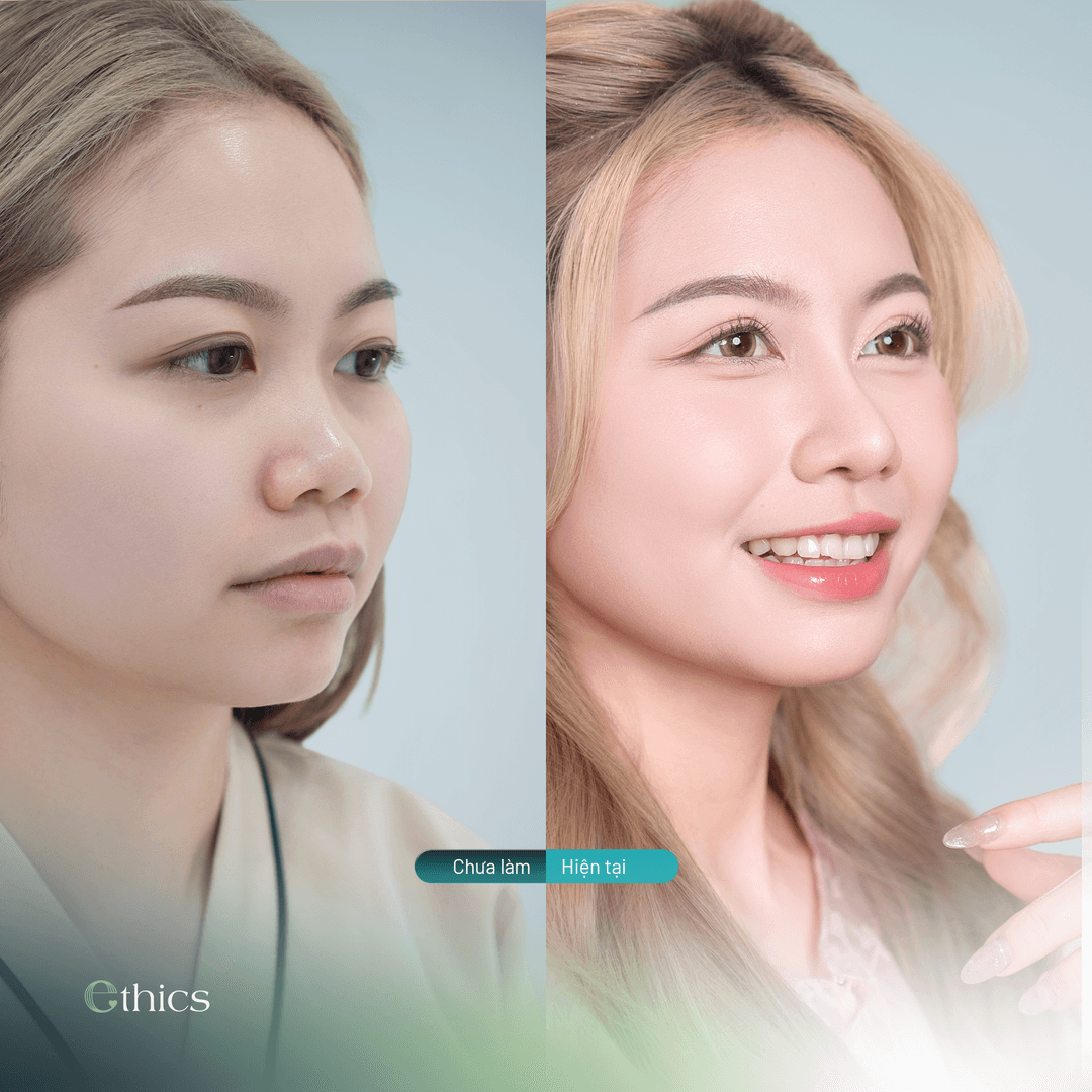 Before and after rhinoplasty comparison image of the patient