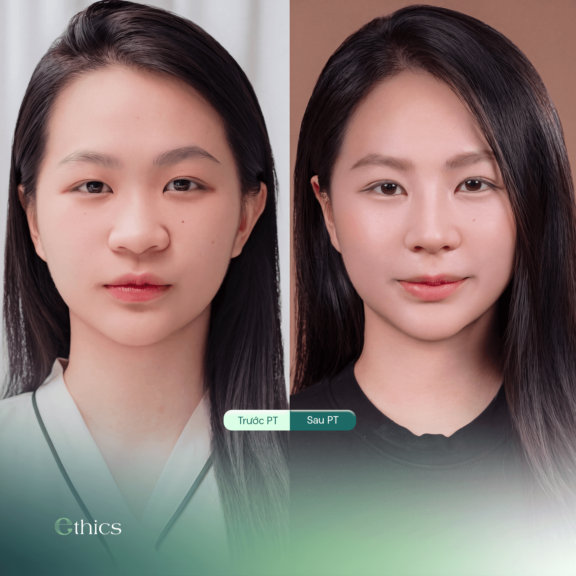 How should the rib cartilage donor site be cared for after rhinoplasty?