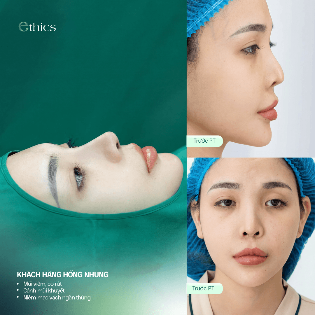 STRUCTURAL CARTILAGE RHINOPLASTY - SOLVING COMPLEX NOSE SHAPES