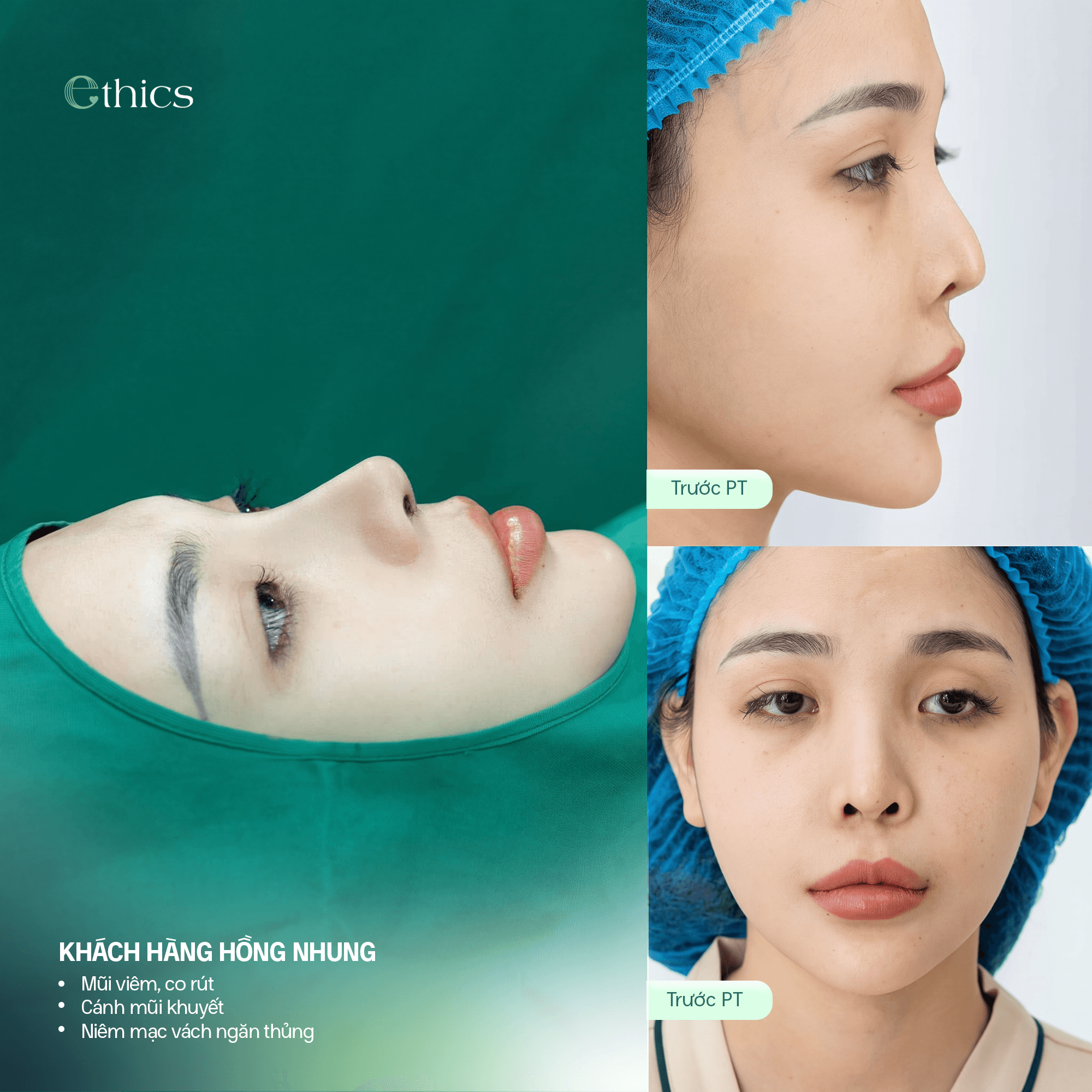 NÂNG MŨI CẤU TRÚC SỤN SƯỜN - CHINH PHỤC MỌI DÁNG MŨI PHỨC TẠP