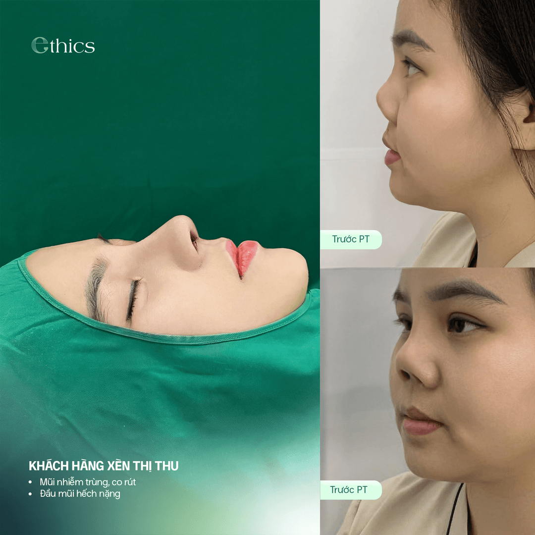 Image comparing the patient's nose before structural rhinoplasty