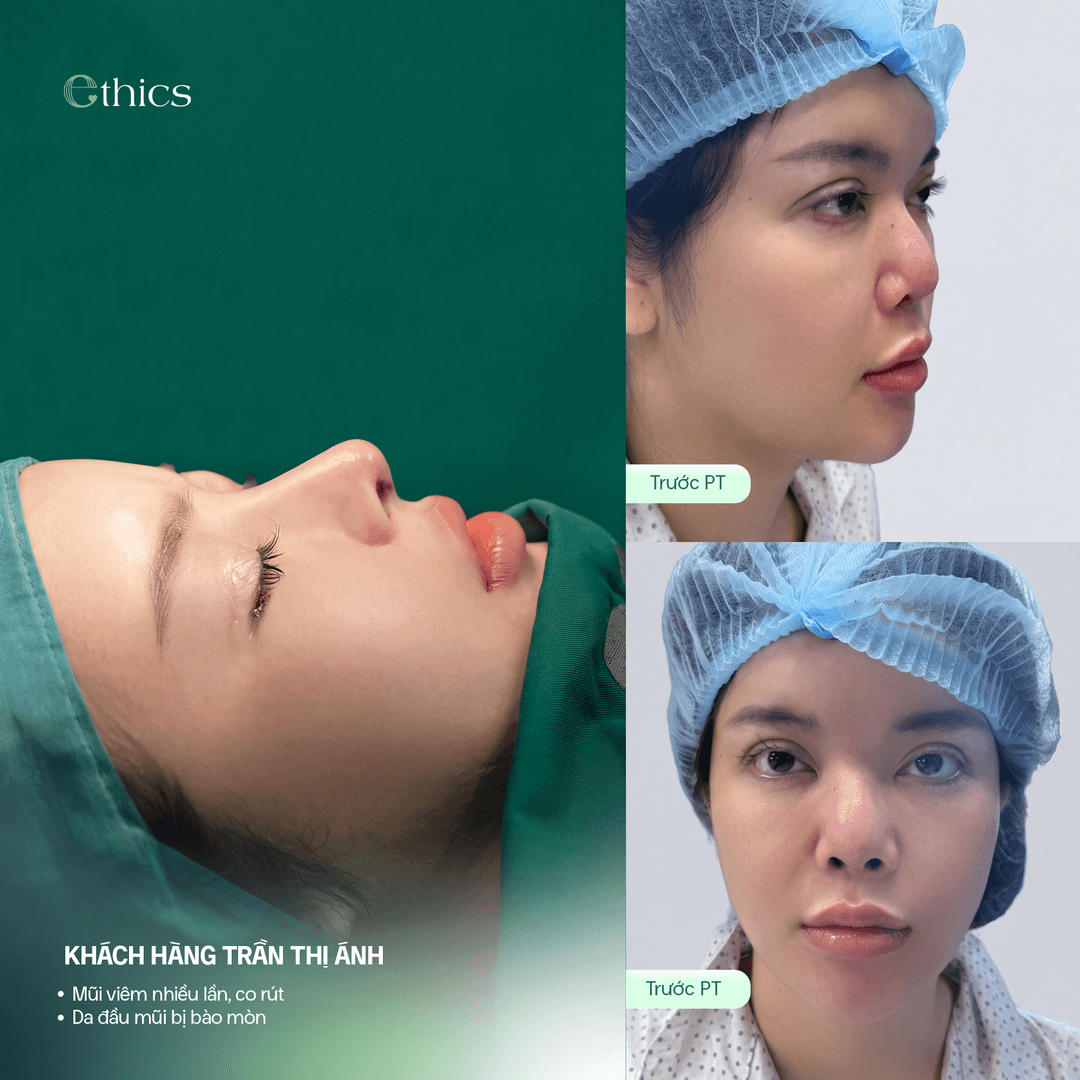 Image of a patient before structural rib cartilage rhinoplasty