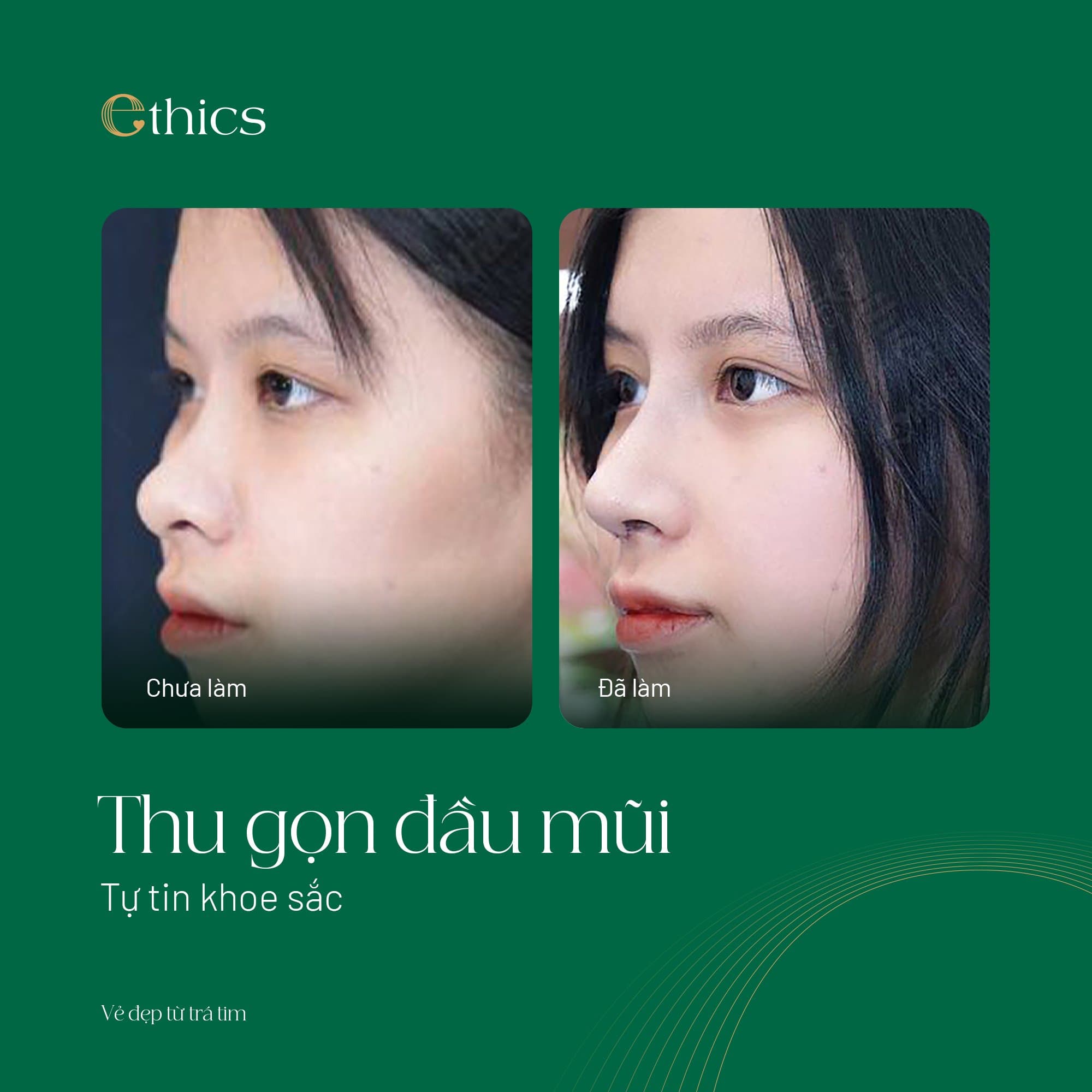 Nose Tip Reduction